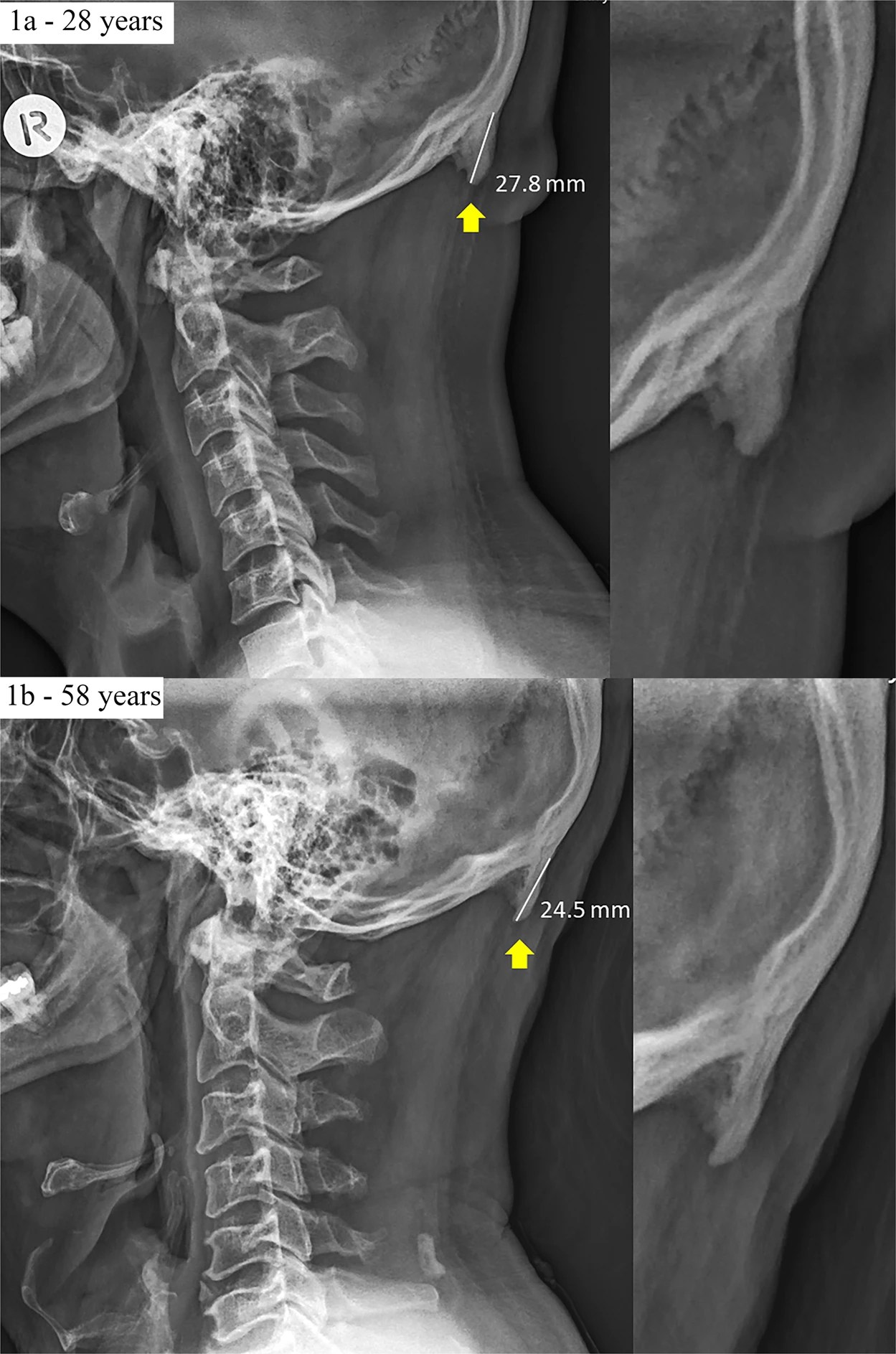 From: Prominent exostosis projecting from the occipital squama more substantial and prevalent in young adult than older age groups - Clearly, the cross-sectional nature of this retroactive case study means that we are unable to draw direct causal links between EEOP formation and other issues such as poor posture and/or the use of mobile phones and other hand-held modern technologies. We acknowledge factors such as genetic predisposition and inflammation influence enthesophyte growth. Similarly, we acknowledge that most of our data were taken retrospectively from a clinician’s database of lateral cervical radiographs, with many individuals therefore originally seeking clinical advice and/or presenting with mild symptomology. Accordingly, despite our exclusion criteria, care should be taken to avoid over generalising these results to an asymptomatic general population. However, the high numbers of EEOP in the 18-30 age group suggests a potential avenue for prevention intervention through posture improvement education in this cohort. - Example radiographs of two male participants (28-years-old and 58-years-old) presenting with large enthesophytes emanating from the occipital squama. These images also include the enthesophyte measurements used throughout this study. Scientific Reports (Sci Rep) ISSN 2045-2322 (online).